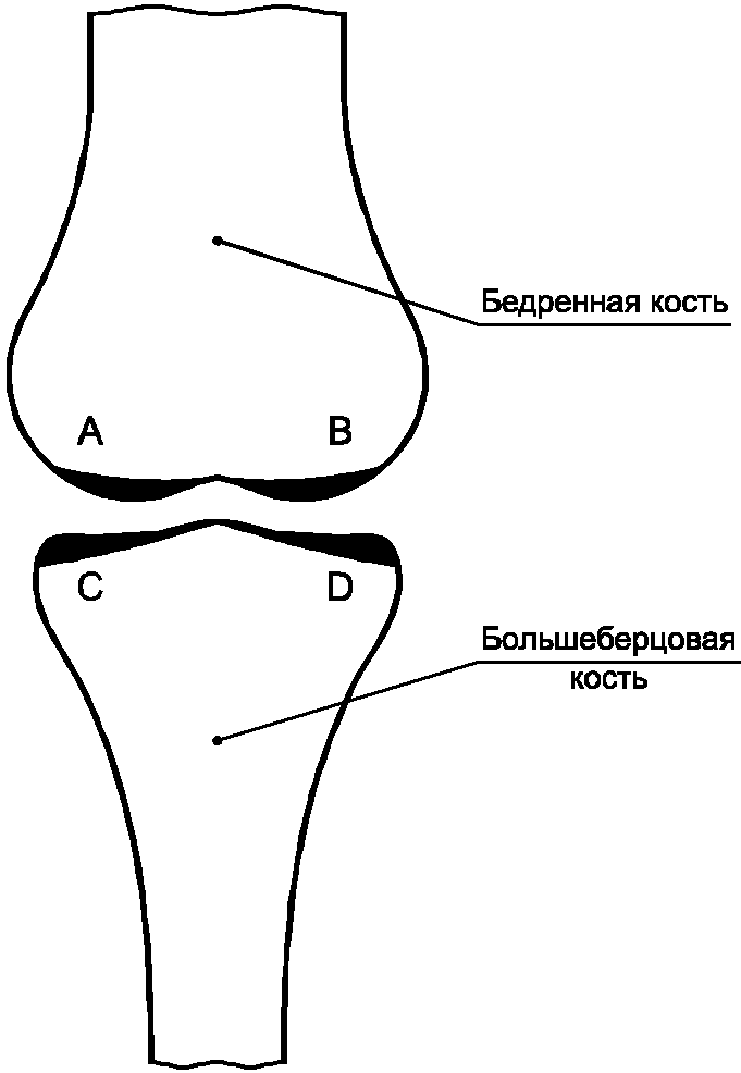 Мыщелки бедренной и большеберцовой кости. Выкройка защиты на коленную чашечку. ГОСТ коленные имплантаты.