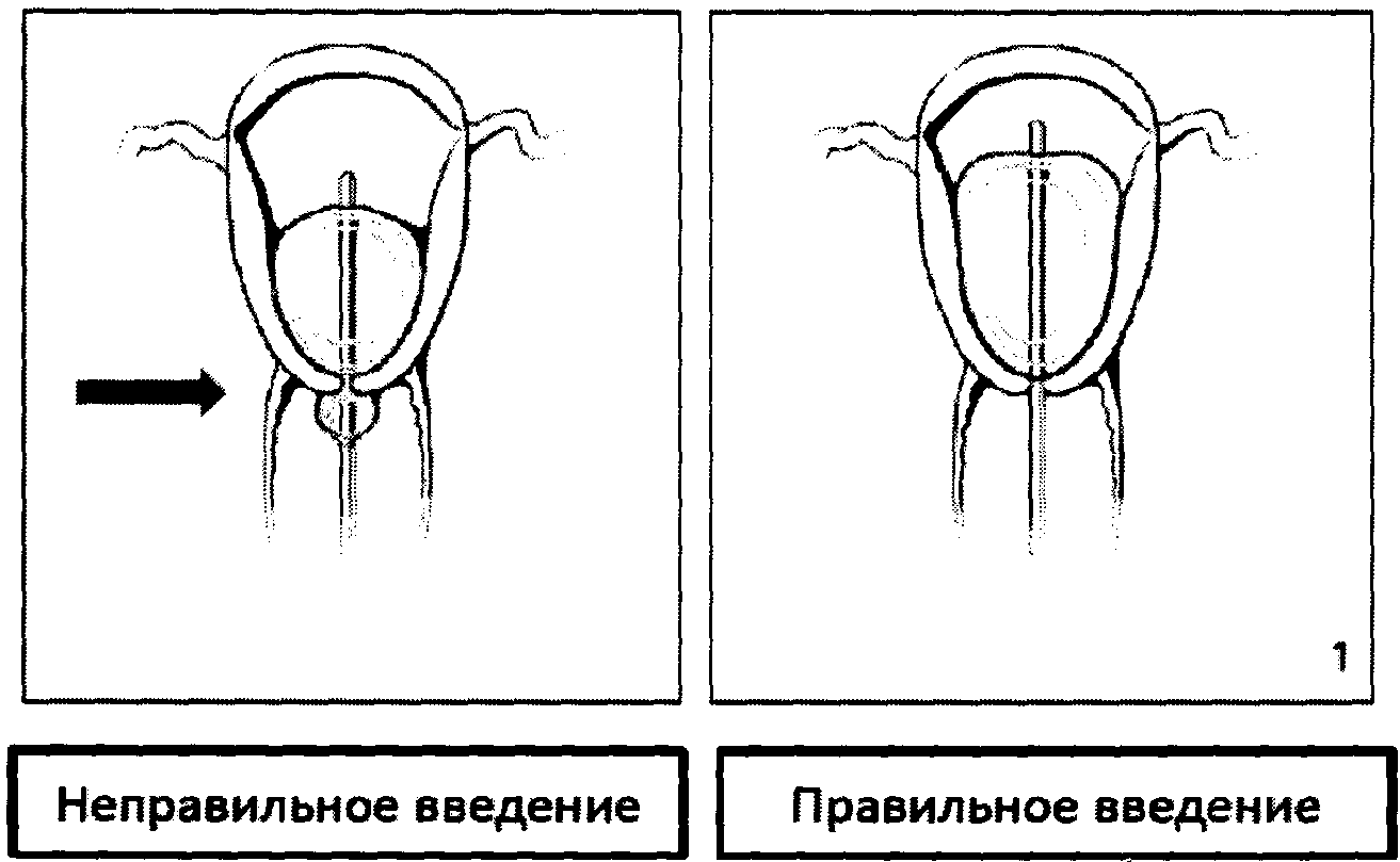 Баллонная тампонада матки презентация