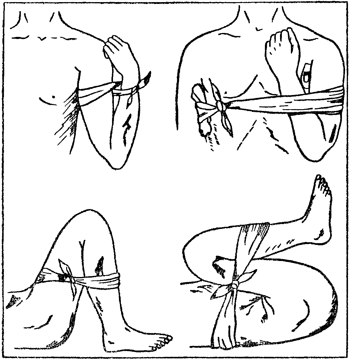 Временные способы остановки артериального кровотечения. Остановка кровотечения сгибанием конечности. Остановка кровотечения максимальным сгибанием. Остановка артериального кровотечения. Максимальное сгибание конечности для остановки кровотечения.